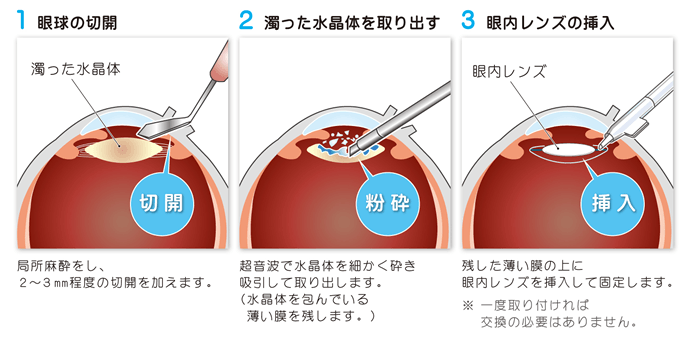 白内障