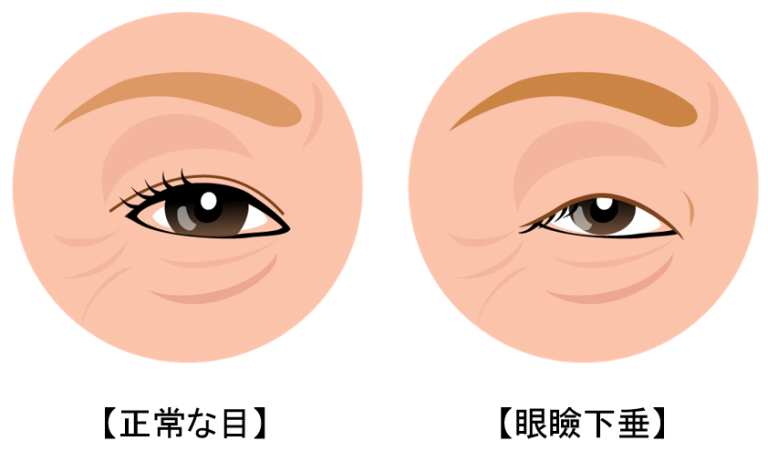 眼瞼下垂の例