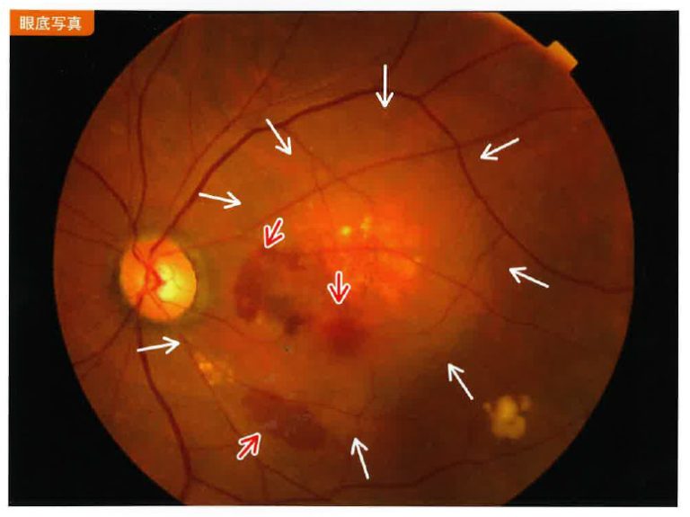 加齢黄斑変性_眼底写真