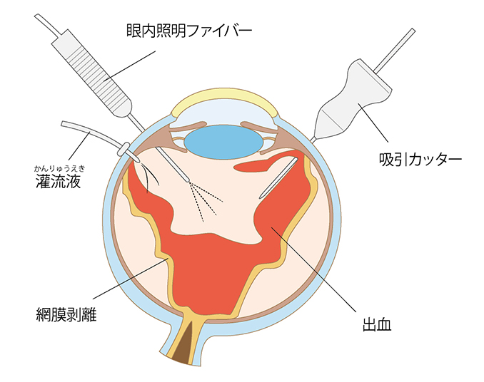 硝子体手術 