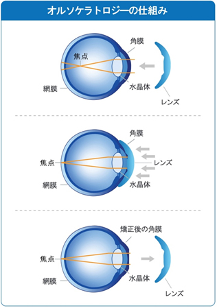 オルソケラトロジーの仕組み